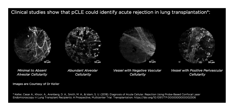 Lung Inflammation.png